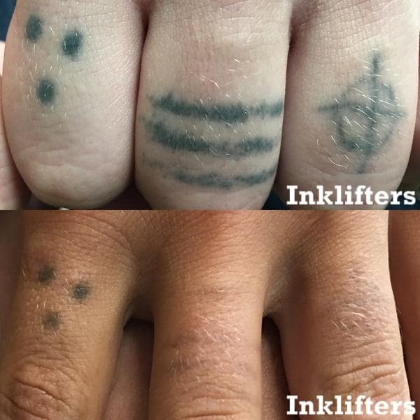 picoway tattoo removal