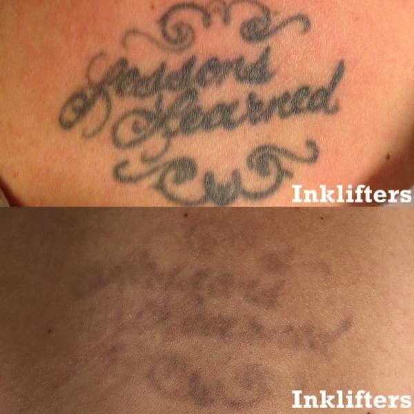 tattoo removal orem
