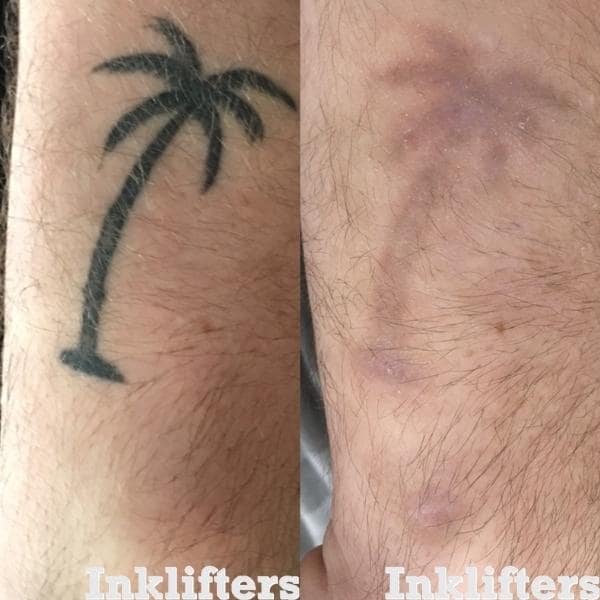 laser tattoo removal Utah