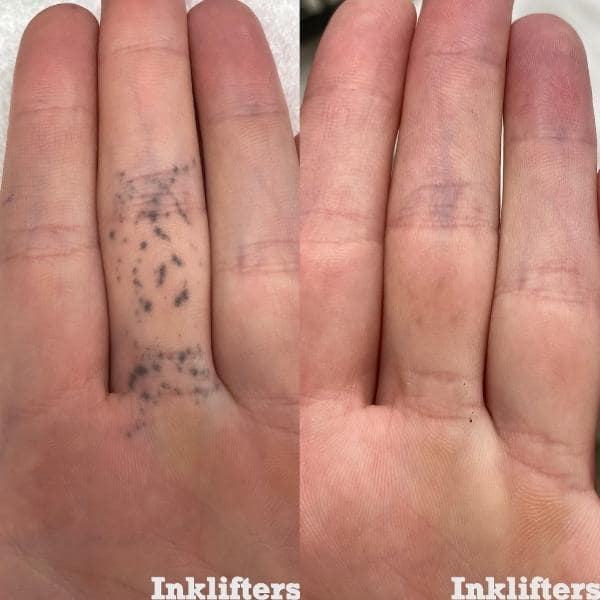 tattoo removal salt lake city