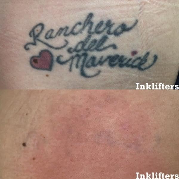 tattoo removal utah