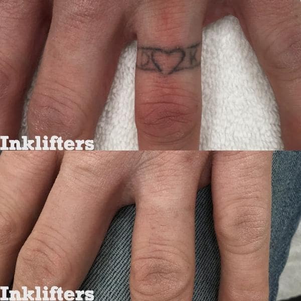 laser tattoo removal utah