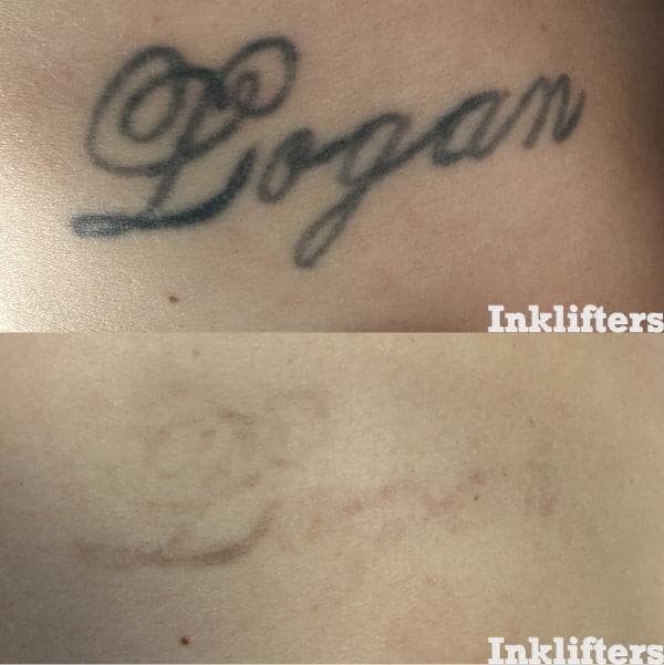 pico laser tattoo removal utah