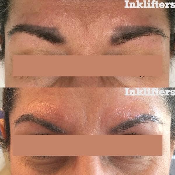 tattoo removal salt lake city