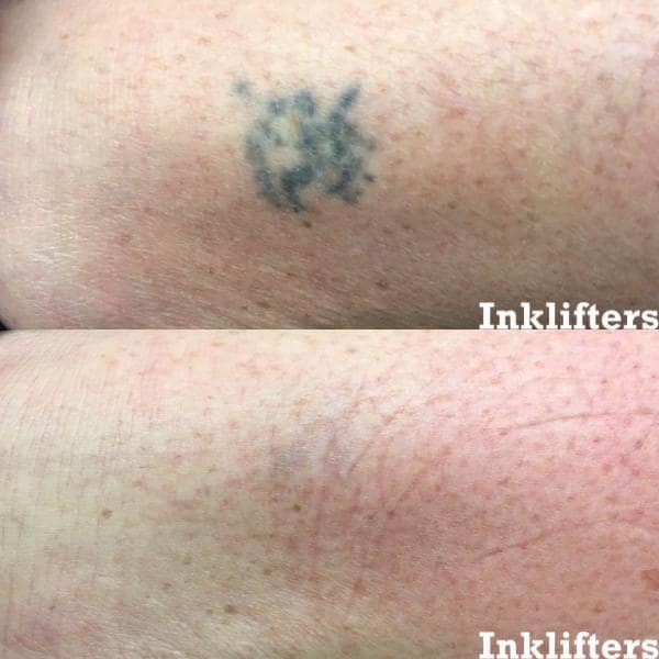 tattoo removal utah county