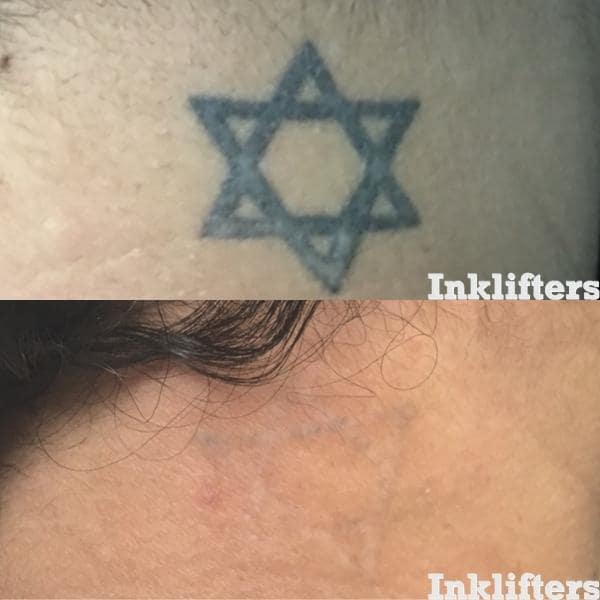 tattoo removal provo