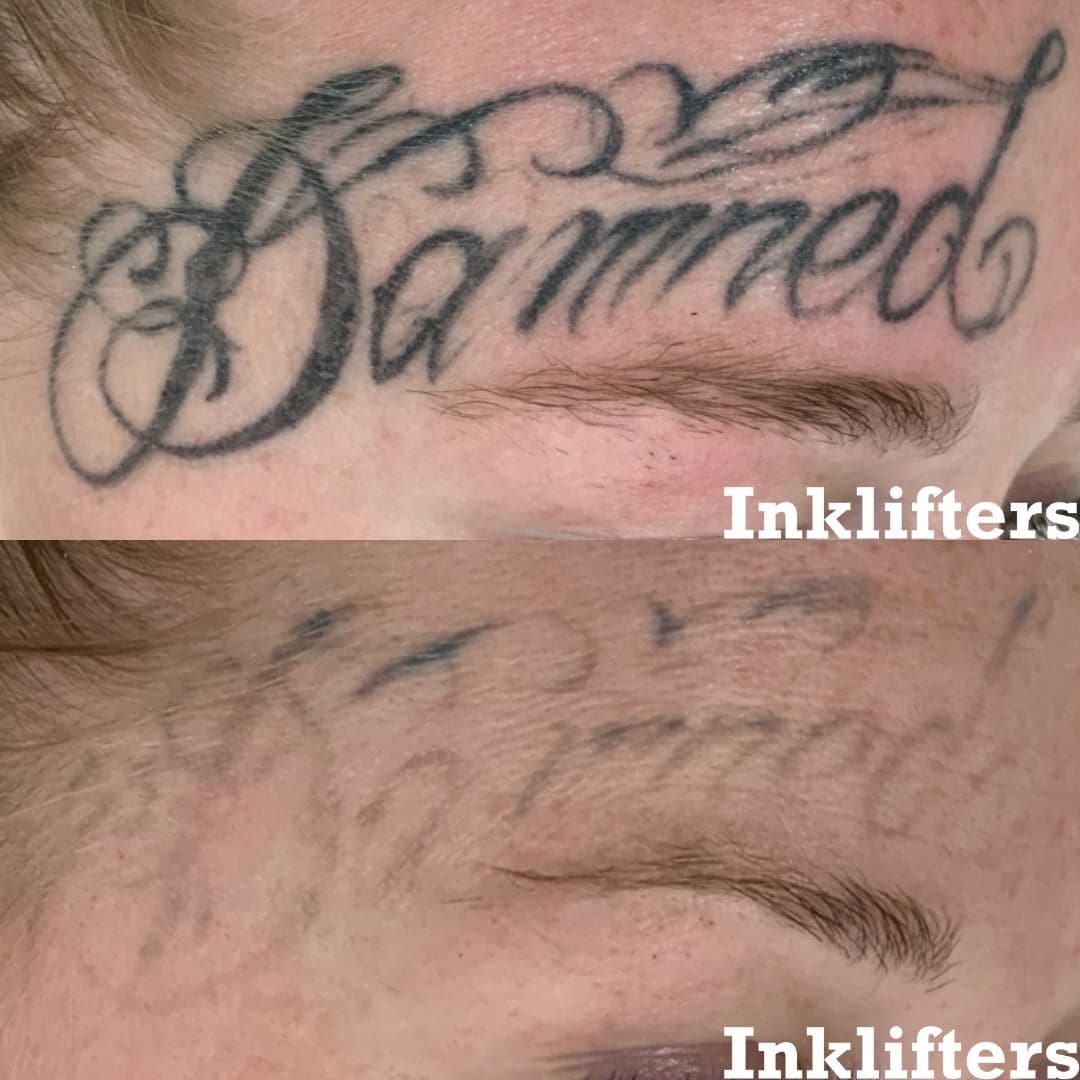 laser tattoo removal utah