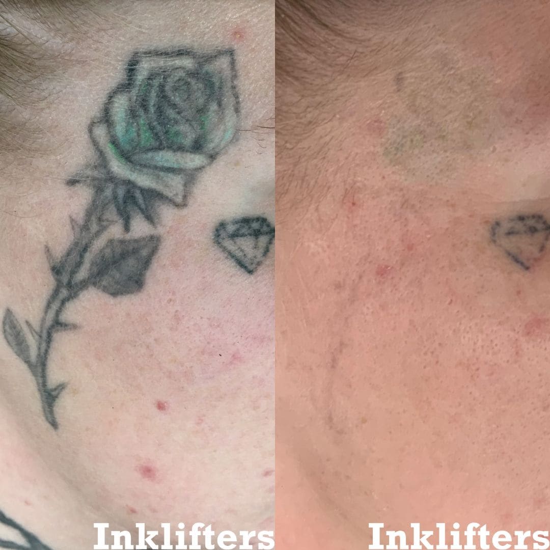 laser tattoo removal before and after