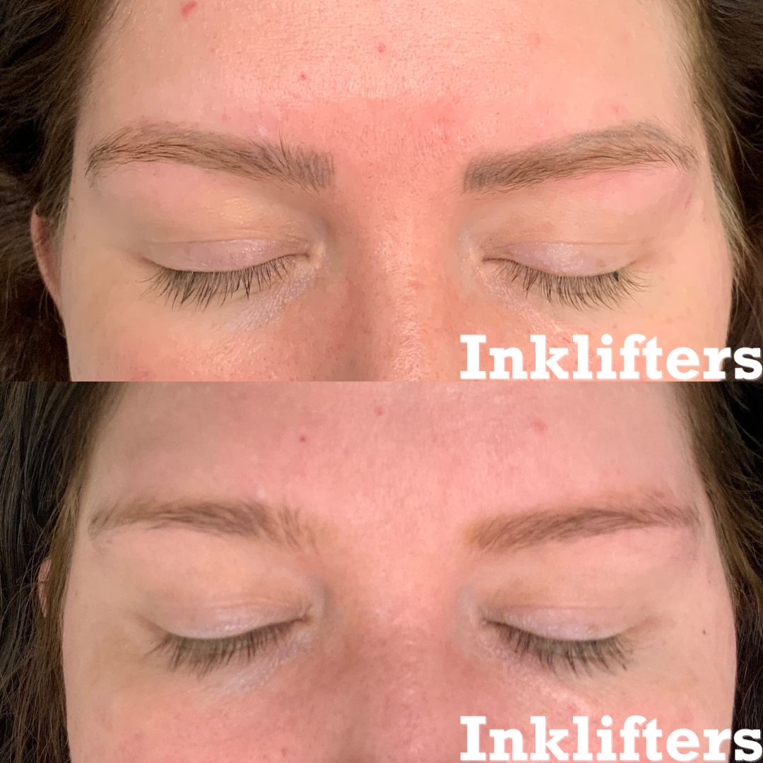 microblade removal utah