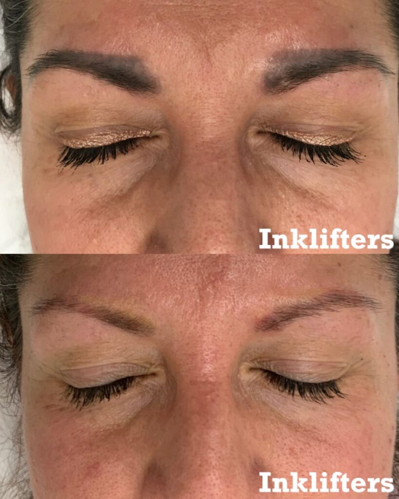 microbladed eyebrow removal before and after