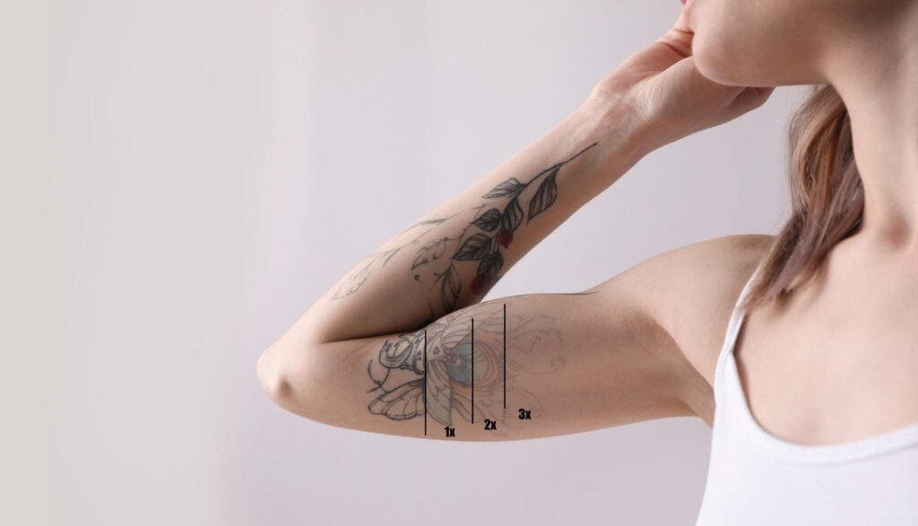 science behind laser tattoo removal
