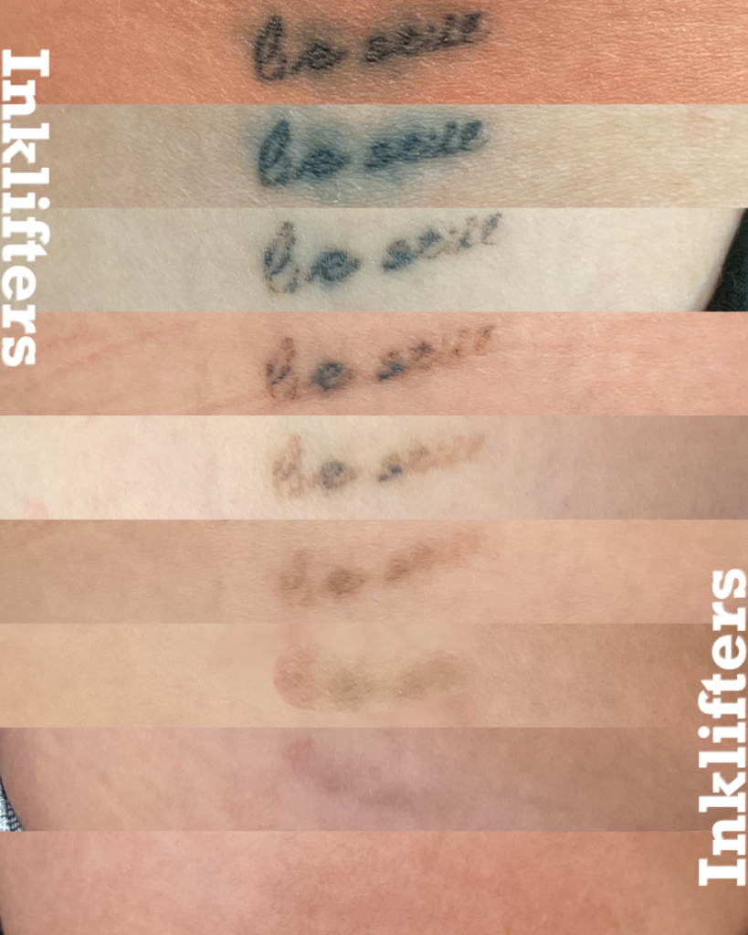 laser tattoo removal results