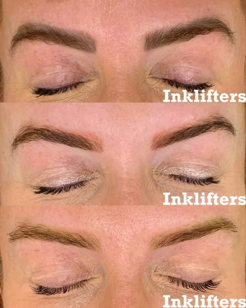 microblading removal before and after