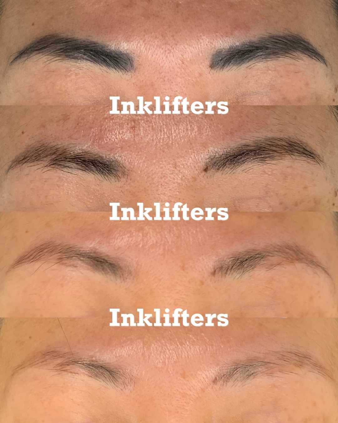 microblading laser tattoo removal